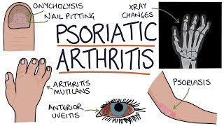 Psoriatic Arthritis [upl. by Gavini]