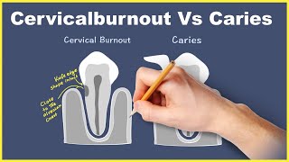 Cervical burnout Vs Caries Radiology concept [upl. by Nessy]