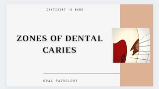 DENTAL CARIES ZONES [upl. by Ynamrej]