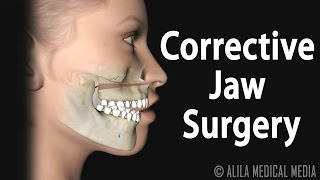 Corrective Jaw Orthognathic Surgery Animation [upl. by Crooks942]