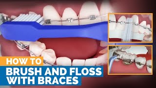 How to Brush amp Floss with Braces [upl. by Amis]