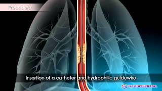 Esophageal Stent [upl. by Samaj]