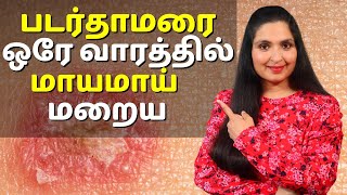 படர்தாமரை மற்றும் தழும்பு ஒரே வாரத்தில் மாயமாய் மறைய  Quickest Way to Get Rid of RINGWORM [upl. by Reffotsirk]