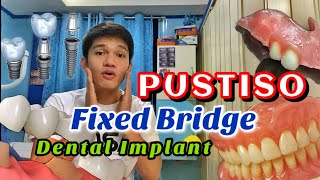 PUSTISO  Fixed  removable and Implant Pamalit sa nabunot na ngipin [upl. by Brook]