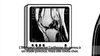 Larthrose est une maladie qui se soigne [upl. by Whiteley755]