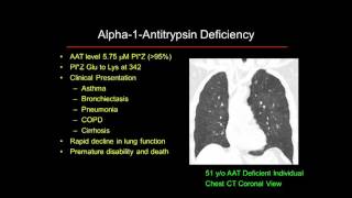 Alpha1 Antitrypsin Deficiency 101 Lung [upl. by Ardussi986]