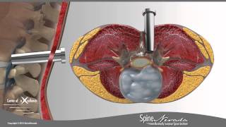 Lumbar Microdiscectomy  Spine Center Northern Nevada Northern California  Spine Surgery [upl. by Saihttam]