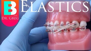 BRACES EXPLAINED Elastics  Rubber Bands [upl. by Leafar550]