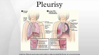 Pleurisy [upl. by Eiramac]