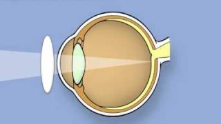 Retinoscopy of the eye Ophthalmology [upl. by Dania]