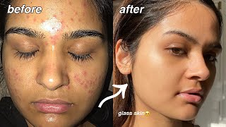 how i cleared my acne FOR GOOD something finally worked [upl. by Pradeep]