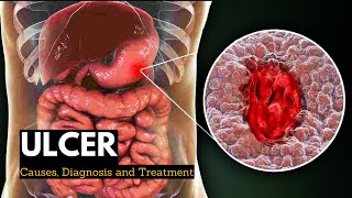 Ulcer Causes Signs and Symptoms Diagnosis and Treatment [upl. by Grussing]