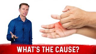 What Causes Sweaty  Dry Hands amp How To Get Rid Of It – Dr Berg [upl. by Mercado]