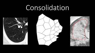 Chest Radiology  Patterns  Airspace [upl. by Airamat]