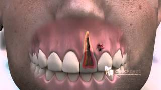 How to treat a dental Fistula [upl. by Romelle775]