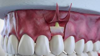 Subepithelial Connective Tissue Grafting [upl. by Mohun189]