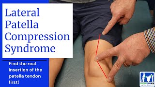 Lateral Patella Compression Syndrome LPCS [upl. by Teleya]