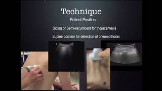 US Guided thoracentesis CUSE 2018 [upl. by Ahsimin]