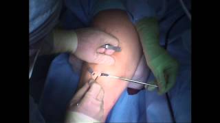 ACL Surgery  First Incision [upl. by Moreno]