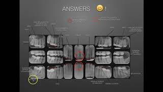 The Full Mouth Xray Survey Identification amp Film Mounting [upl. by Housum]