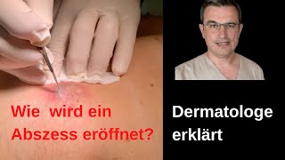 Dermatologe kommentiert Öffnen einer infizierte Zyste mit Abszess drkasten abszeß [upl. by Belanger71]