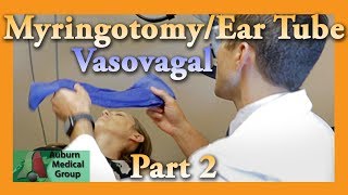 739  Infected Aural Polyp Ear Wax Removal [upl. by Lanahtan]