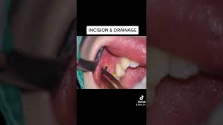 TOOTH ABSCESS Incision amp drainage [upl. by Lucier]