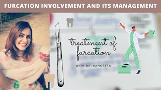 furcation involvement treatment easy explain [upl. by Perkin]