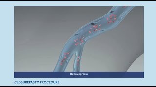 Varicose Veins Treatment ClosureFast Procedure Animation [upl. by Yenttihw]