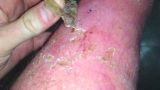 peeling scab  Sunburn [upl. by Kerred]