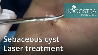 Sebaceous cyst  Laser treatment 20150 [upl. by Einnaf]