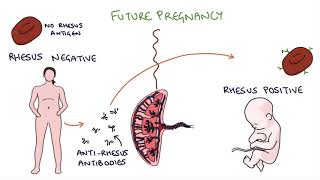 Understanding Rhesus Status and AntiD in Pregnancy [upl. by Eire]