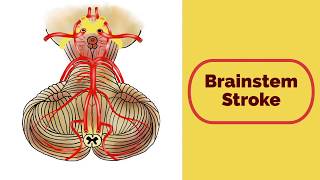 Brainstem Stroke Syndromes [upl. by Leiram252]