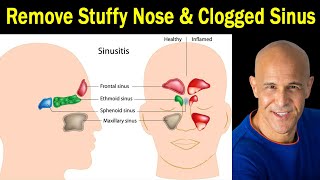 4 Proven Techniques for Stuffy Nose amp Clogged Sinus  Dr Alan Mandell DC [upl. by Meraree880]