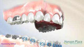 How a Fixed Bite Plate Works [upl. by Helman]