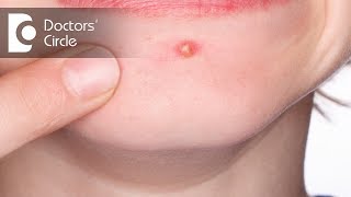 Causes and management of Scabies with pus filled pimples  Dr Aruna Prasad [upl. by Anirehtac]