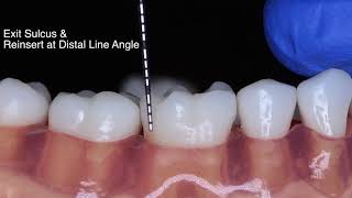 Periodontal Probe Basic Technique [upl. by Estevan]