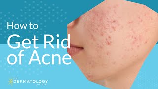 Acne Treatment  Explained by Dermatologist [upl. by Elitnahc619]