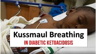 Kussmaul Breathing in Diabetic Ketoacidosis [upl. by Himelman674]