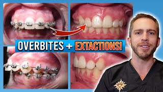 Braces Overbite Treatment BEFORE amp AFTER [upl. by Connett]