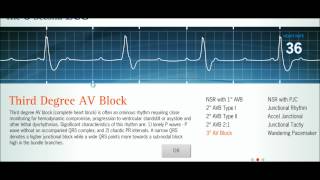 Easy EKG Interpreting Rhythms [upl. by Attennyl340]