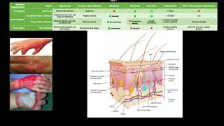 Classifying Burns EXPLAINED [upl. by Donnell]