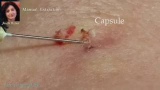 Josefa Removal of a Sebaceous Cyst gigantic blackhead [upl. by Kcirdla]