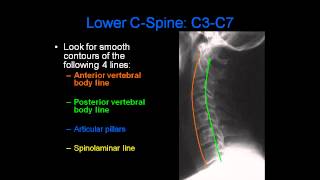 Radiology of Spine Trauma [upl. by Gnoht]