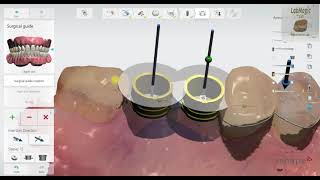 3Shape Implant Studio 2020 Detailed Workflow [upl. by Yehc]