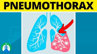 Pneumothorax Medical Definition  Quick Explainer Video [upl. by Aleb]