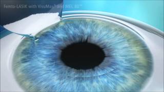 LASIK Treatment Animation [upl. by Crandall]