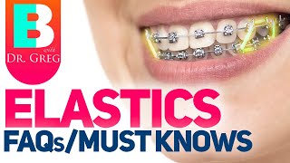 Braces Elastics  Rubber Bands – 5 Most Common Questions [upl. by Arakahs]