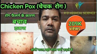 chicken pox in Hindi चेचक रोग  छोटी माता ओर बड़ी माता रोग ओर बचाव  symptoms and Treatment  RDMS [upl. by Robinet80]