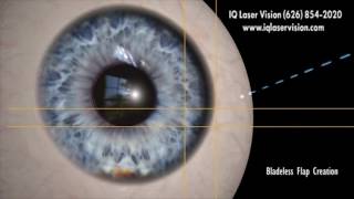 LASIK Eye Surgery for Astigmatism with LasikPlus [upl. by Karrie]